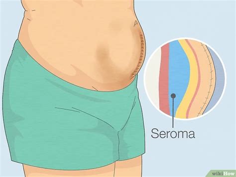 Seroma After Spay: A Common Surgical Complication